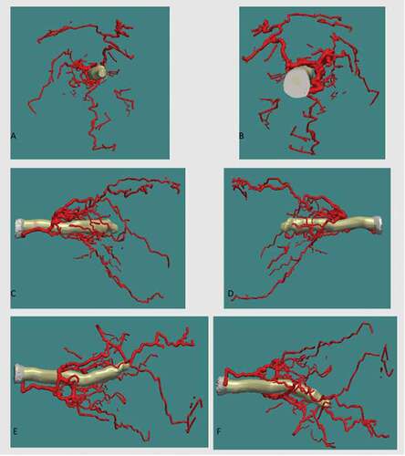 Figure 6. Three-D reconstruction of retrobulbar arterial system in relation to the optic nerve viewed from, (A) anterior, (B) posterior, (C) lateral, (D) medial, (E) superior, (F) inferior. Superior (S), inferior (I), anterior (A), posterior (P), medial (M), lateral (L)