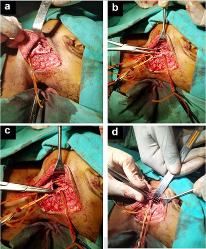 Figure 4 Intraoperative images showing dissection of the anatomical layers (a), freeing of the carotid arteries (b), and opening of the aneurysm sac (c and d).