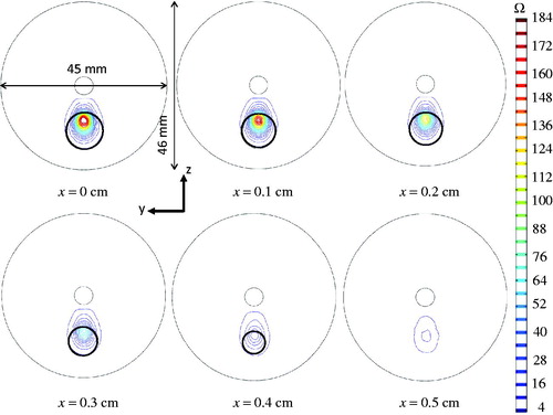 Figure 10. Sagittal views of the thermal damage at t = 630 s on different sagittal slices.