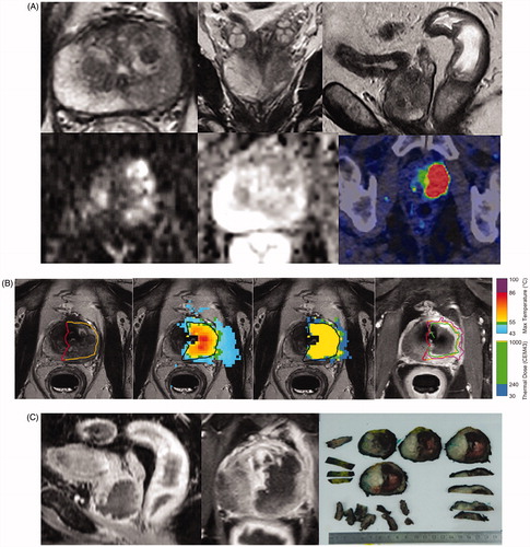 Figure 2. (A) Patient 4: A 70-year-old (ECOG 0, prostate volume 51 cc, BMI 30) Caucasian man without urinary symptoms and with elevated PSA level 36 ng/mL underwent pre-biopsy prostate MRI showing a left lobe situated 5.1 cc PIRADS 5 lesion in the close contact with prostate capsule. Axial, coronal and sagittal T2-weighted images on top panel (left to right in order); diffusion weighted and apparent diffusion coefficient images on bottom panel (left and middle) from the PIRADS 5 lesion. All the MRI-targeted 6-core biopsies confirmed Gleason Score 4 + 3=7 PCa within the dominant lesion with cancer core length of 53 mm. The whole-body contrast-enhanced computer tomography (CT) and bone scintigraphy were both negative for metastasis. F18-prostate-specific membrane antigen (PSMA) positron emission tomography-CT excluded distant metastasis and showed an intensive PSMA-uptake with standardized uptake value maximum of 81.1 g/mL in the left lobe of the prostate concordant with the MRI (on bottom panel left). (B) Immediate post-treatment overlay images have been demonstrated from the active element of the patient 4: on the left targeted region; on the middle maximum temperature and thermal dose maps and on the right non-perfused volume (NPV). Yellow boundary demonstrates targeted region on treatment planning, purple 240 CEM43 isodose boundary and green 55° isotherm boundary. (C) This figure presents post-TULSA NPV on sagittal and axial images at 3 weeks just prior to RALP procedure and the sliced RALP specimen on the right, in which thermal damage region is clearly identified as the dark regions on the gross specimen.