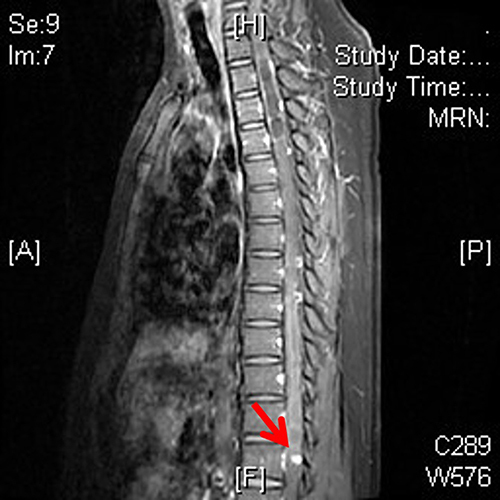 Figure 2 Multiple hemangioblastomas (the red arrow) seen on thoracic spine MRI (patient two).