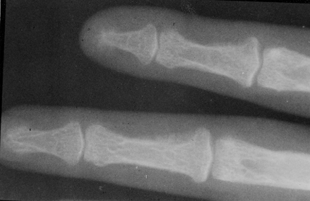 Figure 6. Subperiostal bone resorption of the radical side of the middle phalanges 2. and 3. finger-pathognomone sign for hyperparathyroidism.