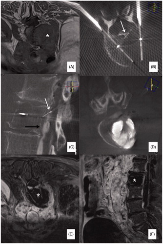 Figure 3. (A) Painful metastatic involvement of L2 (*) in a 77 years old female patient affected by bladder cancer. (B) Two 20 mm active tip RFA electrodes were deployed through a trans-pedicular approach and several different impacts were performed. (B, C) A thermocouple was deployed through a descending trans-foraminal approach (white arrow); epidural hydro-dissection was performed through the same approach (black arrow). (D) Vertebral augmentation was subsequently performed. (E, F) Contrast enhanced T1-weighted sequence obtained 24 h after RFA shows the extension of the necrotic area (*).