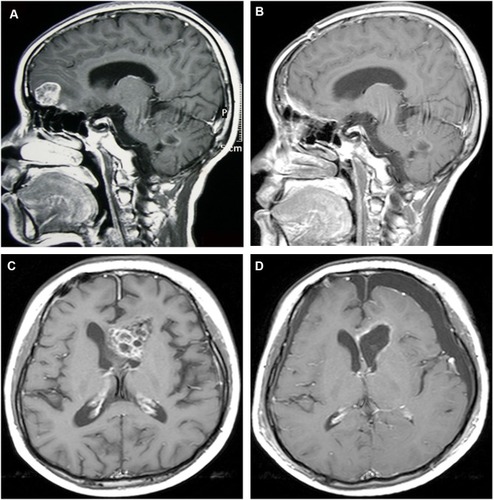 Figure 4 Representative neuroimages of two cases with NM receiving operations. (A, B) A 21-year-old woman suffering from the disseminated medulloblastoma with the massive subtype in the anterior skull base (A) received the gross total removal of NM (B). A 16-year-old boy with metastatic GCTs in the left ventricle (C) received the gross total resection of NM (D).
