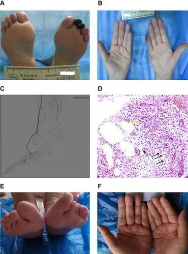 Figure 1 Variation of the gangrene tissues and histopathologic examination of necrosis extremities. (A and B) Initial presentation of necrotic toes and finger without a defined boundary at admission. (C) Limb angiography of left leg, with well-collateral circulation. (D) Histopathologic examination of necrosis toes with dead blood vessel (yellow arrow), white cells rupture and remained nuclear dust (black arrows), (original magnification x400). (E and F) Toes and fingers healed entirely.