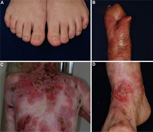 Figure 1 Clinical features of dystrophic epidermolysis bullosa.