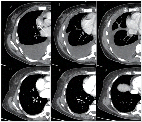 Figure 1. Stability of disease with minimal reduction of the known breast lesions at the start of therapy (A, B, C) and until in April 2014 (D, E, F)