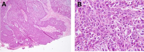 Figure 3 Pathology slides from total thymus resection showed thymic carcinoma composed of epitheloid tumor cells with nuclear pleomorphism, apparent nucleoli, and mitotic features (H&E, 400×) in solid nest or sheet arrangement (H&E, 100×).