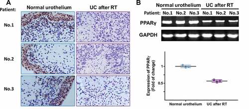 Figure 3. The expression of PPARγ was examined in specimens of normal urothelium and UC after RT using immunohistochemistry (a) and RT-PCR (b). Three representative images were shown