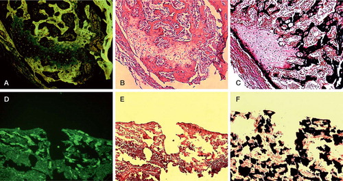 Figure 4. Evaluation of the calcification status was performed using oxytetracyclin staining (A, D), and v. Kossa/v. Giesson staining (C, F). Calcified structures appear green using oxytetracyclin and black using v. Kossa/v. Giesson staining, respectively. Note that the former substantial defect is covered with a subtle calcified layer in the non-inactivated group (A, C), whereas the control group shows no calcification process (D, F). H & E staining (B, E) was performed to evaluate bone-remodeling areas with cartilage (blue), chondrol ossification (pink) and calcified structures (red). While the control group was characterized by the absence of any repair mechanisms (E), the non-inactivated group showed viable bone with normal cellularity in the myeloid cavity and chondrol ossification in the former substantial defect area (B). Bar represents 300 μm.