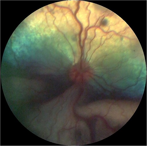 Figure 3. Fundic photograph of a dog with ocular protothecosis showing multifocal hypo-reflective areas of active chorioretinitis and an opaque, ventral, exudative retinal detachment. Image courtesy of Marnie Ford, Animal Eye Care, Melbourne, Australia.