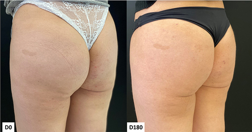 Figure 14 Case 7, Buttocks Beautification 3D. Standardized oblique images pre and 180 days post injection.