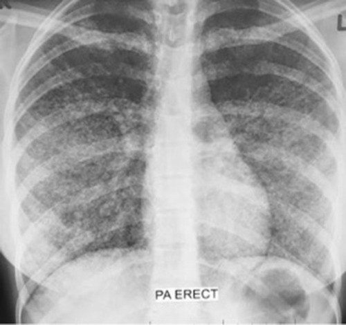 Figure 2 Anteroposterior chest radiography demonstrated diffuse reticulonodular opacities (nodular> reticular) involving the bilateral hemithorax with background ground glass haziness.