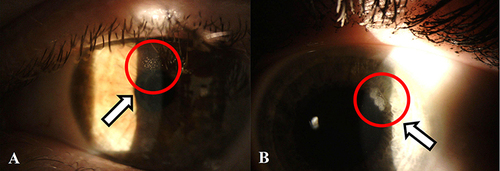 Figure 1 Slit lamp images depicting various epithelial ingrowths after SMILE. White arrows point to red circled area of involvement; both speckled (A) and pooled (B) appearances are considered epithelial ingrowths.