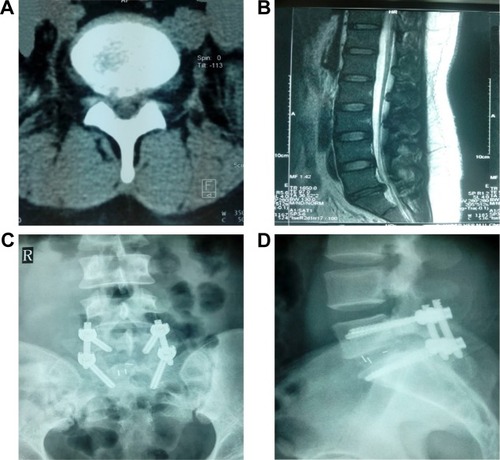 Figure 2 A case of PLIF surgery.