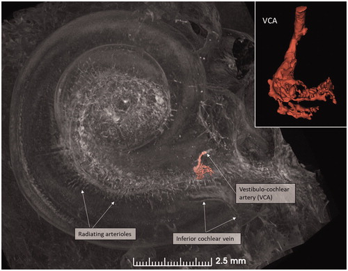 Figure 6. SR-PCI image of a right human cochlea. The VCA was segmented and is shown in higher magnification in the inset. After entry into the modiolus, it divides into several small arteries or plexus.