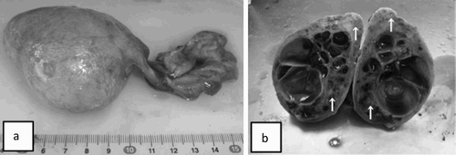 Figure 2. Gross appearance of the extracted left ovary. The extracted left ovary (60 mm × 70 mm × 70 mm, 117 g in weight) was coated smooth surface (a). The cut surface revealed many various-sized cystic follicles filled with yellowish serous fluids and greyish-yellow solid parts (↑) (b).