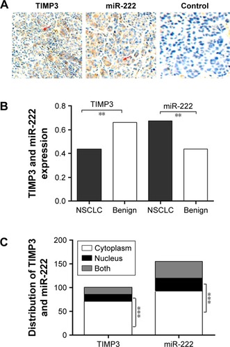 Figure 1 Expression and distribution of TIMP3 and miR-222 in lung cancer. Table 1 Relationship between both proteins expression and TNM stageDownload CSVDisplay Table