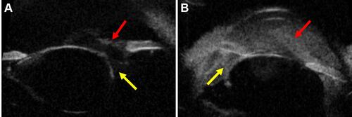 Figure 5 (A) An ultrasound biomicroscopic (UBM) image illustrating zonular tear (Yellow arrow) along with vitreous in the anterior chamber (Red arrow) in a 27-year-old patient with penetrating trauma. (B) An ultrasound biomicroscopic (UBM) image illustrating zonular tear (Yellow arrow) with dense hyphema in the anterior chamber (Red arrow) in a 36-year-old patient with blunt trauma.