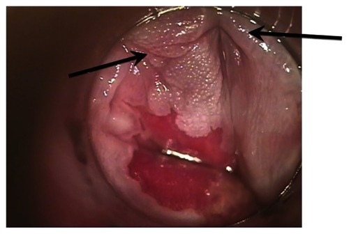 Figure 4 This figure illustrates the effect of incorrectly applying topical 5-fluorouracil. The patient applied 5-fluorouracil with one hand only and left one area of HGAIN incompletely treated. The arrows point to the HGAIN that was incompletely treated.