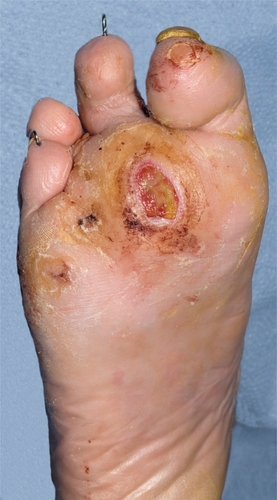 Figure 1 Infection in ulcer bed with mild surrounding erythema.