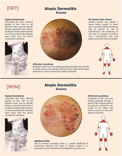 Figure 2. Atopic dermatitis bespoke resources for the HET and HOM variable groups.