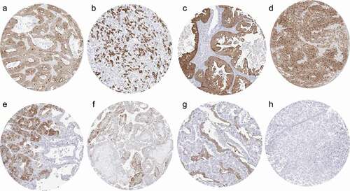 Figure 2. Villin immunostaining in cancer. The panels show a strong villin staining in a colorectal adenocarcinoma (a), a gastric adenocarcinoma (b), a mucinous ovarian carcinoma (c), and a muscle-invasive urothelial carcinoma (d). A focal positivity is seen in an adenocarcinoma of the lung (90% of tumor cells; e) and a papillary renal cell carcinoma (50% of tumor cells; f). A strong villin staining also occurs in Yolk sac tumor components of a mixed germ cell tumor also containing villin-negative embryonal carcinoma (g). Villin staining is absent in an invasive breast cancer of no special type (h).