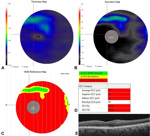 Figure 2 Quantification of ganglion cell complex (GCC) using Fourier-domain optical coherence tomography (FD-OCT) in the case of severe glaucomatous ganglion cell loss. Three different colorimetric maps were automatically computed by the FD-OCT software (RTVue-100 software; Optovue, Inc., Fremont, CA). (A) Thickness map, displaying diffuse blue and black colors indicating severe and diffuse loss of GCC thickness. The central black spot indicates the fovea where the ganglion cells are missing. (B) Deviation map, illustrating the percentage of thickness loss with respect to the normative database. Black coloring indicates a GCC loss of 50% or greater. (C) Significance map, displaying the significant thickness change variation from normal, where green represents values within the normal range (p-value 5–95%), yellow indicates borderline results (< 5%) and red represents results outside the normal limits (< 1%); (D) Quantitative indexes calculated by the software, including average thickness, hemifield thicknesses (superior, inferior and intra-eye) and the two pattern-based diagnostic indexes (i.e., focal loss volume [FLV] and global loss volume [GLV]); (E) Cross-sectional B-scan displays the segmentation used for GCC analysis.