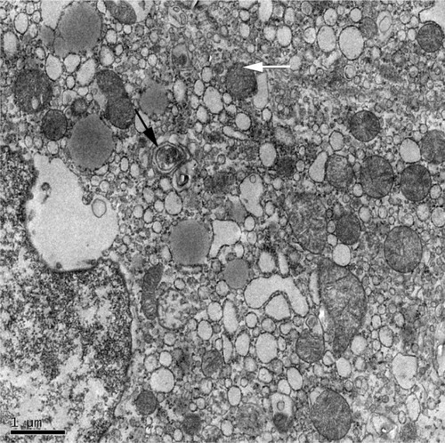 Figure 2 Electron micrograph showing ultrastructure of hepatocytes from a NAFLD mouse model.