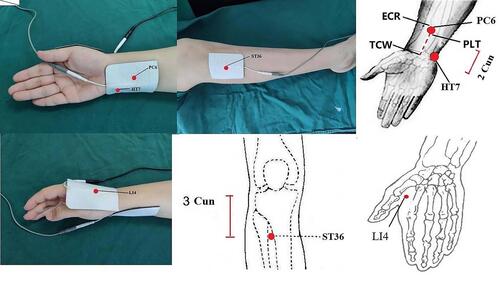 Figure 2 The location of acupoints. The Neiguan (PC6) is located on the palmar side of the forearm, 2 Cun from the TCW, between the ECR and the PLT. The Hegu (LI4) acupoints is located radial to the midpoint of the second metacarpal in the dorsal hand. The Zusanli (ST36) is located 3 Cun below the lower border of the patella, 1 finger’s breadth lateral to the anterior crest of the tibialis anterior muscle. The Shenmen (HT7) is located in the anterior carpal area, the ulnar lateral margia of the distal carpal margin. Cun is defined according to the rules of traditonal acupuncture as the width of the interphalangeal joint of patients’s thumb. TCW: transverse striation of wrist. ECR: extensor carpi radialis. PLT: palmaris longus tendons.