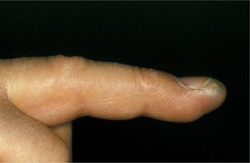 Figure 1 Swelling of the distal phalanx of the right middle finger without prior trauma or infection.