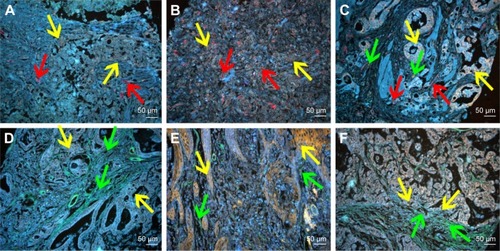 Figure 5 QD probe-based molecular imaging showed the relationship between LOX and other stromal markers.Notes: (A) The expression of LOX was low (yellow arrows), and the MVD (red arrows) was low. (B) The expression of LOX was high (yellow arrows), and the MVD (red arrows) was high. (C) The expression of LOX was high (yellow arrows), and the MVD (red arrows) and infiltrating macrophages (green arrows) were high. (D) The expression of LOX was low (yellow arrows), and type IV collagen (green arrows) was high. (E) The expression of LOX was high (yellow arrows), and type IV collagen (green arrows) was low. (F) The expression of LOX was high (yellow arrows) in the invasion front, and type IV collagen (green arrows) was low. Magnification: 200× (A–F). Scale bar: 50 μm for (A–F).Abbreviations: QD, quantum dot; LOX, lysyl oxidase; MVD, microvessel density.