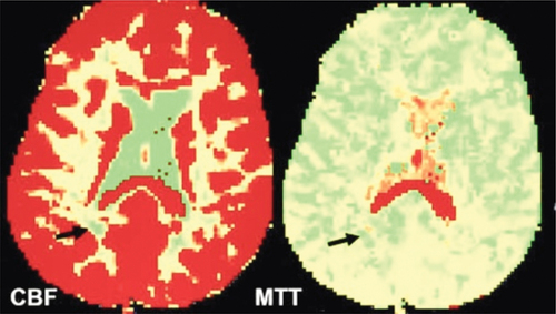 Figure 4. Cerebral blood flow (CBF) and mean transit time (MTT) color-coded maps in MS patient show decreased perfusion with decreased CBF and increased MTT (black arrows).