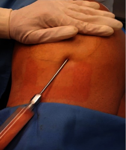 Figure 1 Small-volume liposuction.