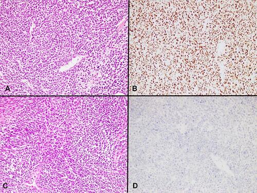 Figure 1 TLE1 IHC staining in synovial sarcoma and Ewing sarcoma. (A) Poorly differentiated synovial sarcoma, H&E, 20x. (B) Strong positive nuclear TLE1 IHC expression in tumor cells, 20x. (C) Ewing sarcoma, H&E, 20x. (D) Negative TLE1 IHC expression in cells of Ewing sarcoma tumor cells, 20x.