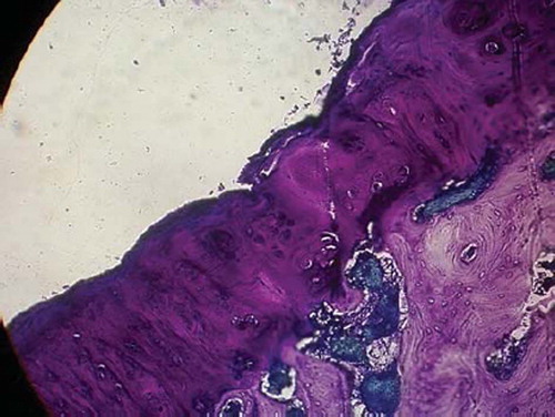 Figures 5. Sagittal sections of cartilage defects transplanted with MSCs derived from adipose (4) at 12 weeks (toluidine blue staining × 400).