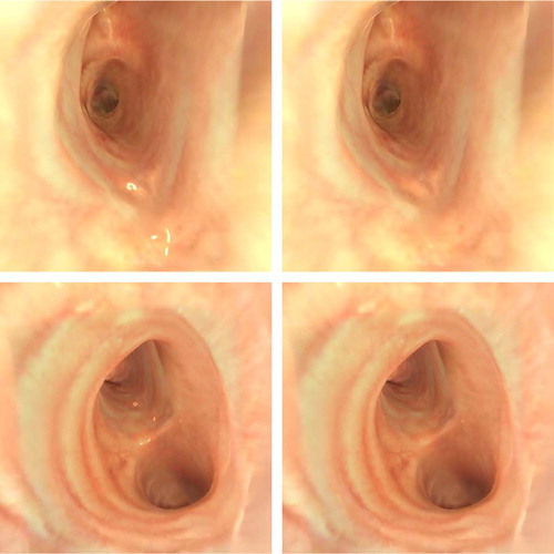 Figure 4. Examples of the patient-specific model rendered with matched BRDF surface texture with and without specular highlights. Models incorporating noise-based specular highlights (left column) generally achieved better scoring in visual realism evaluation experiments than those lacking the same effect (right column). [Color version available online.]