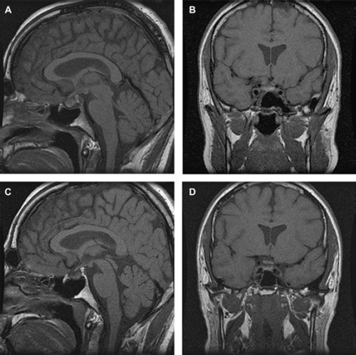 Figure 1. T1-weighted sagittal (A) and coronal (B) magnetic resonance images in a 34-year-old male patient displayed increased signal intensity in the pituitary gland consistent with hemorrhage. The patient developed hypopituitarism in the acute phase of the illness. Three months later (C and D) the pituitary gland had decreased in size, the signal intensity had normalized, as had his hormonal values.