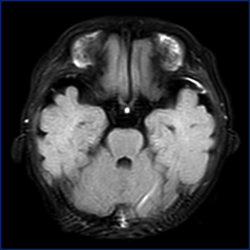 Figure 1 Magnetic resonance imaging of the brain, with contrast. Meningeal enhancement of the left temporal pole on T2-Flair imaging.