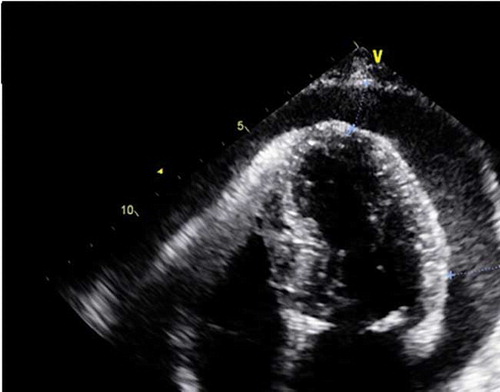 Figure 2.  A two-dimensional echocardiogram showing large pericardial effusion around the whole heart with a thickness of 16–19 mm and no diastolic collapse.