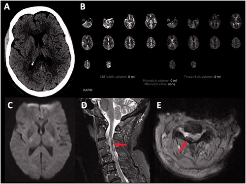 Figure 3. 80-year-old female with atrial fibrillation on apixaban. She presented with a 90-min history of sudden onset right arm and leg weakness sparing the face with normal sensation. A,B: Axial computed tomography (CT) head, CT angiogram (not included) and CT perfusion were unremarkable. Tissue plasminogen activator (tPA) was no given because the patient is on an anticoagulant. C: Diffusion-weighted magnetic resonance imaging (DWI-MRI) was normal. D,E: Sagittal and axial MRI spine revealed right posterolateral epidural haematoma, a multifocal severe spinal canal stenosis, and spinal cord oedema.