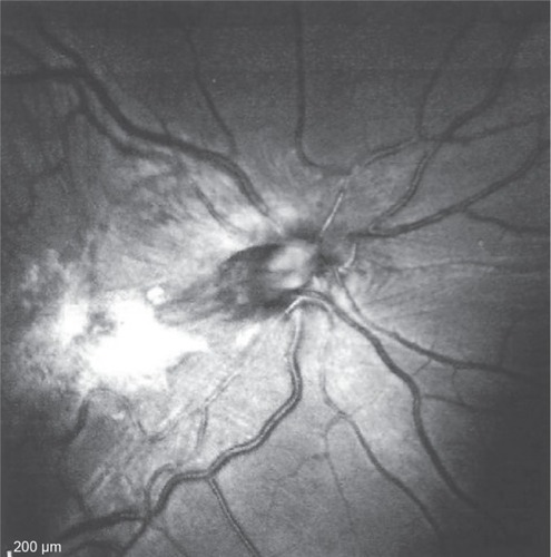 Figure 2 Red-free photograph of the right posterior pole.