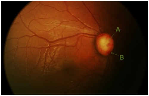 Figure 3 Fundus photograph of the right optic nerve depicting an enlarged cup-to-disk ratio. (A) Cup; (B) disk.