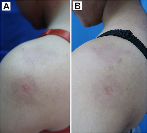 Figure 5 Comparison between skin manifestation on the left shoulder before (A) and after four sessions of PDL treatment (B).