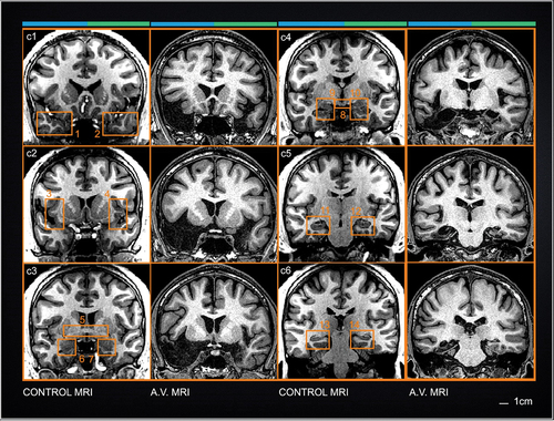 Figure 3. Cross-sectional coronal MRI images through the brain of patient A.V. and an age-matched healthy male. Coronal images provide a comprehensive view of the position of subcortical structures relative to the MTL. Numbered boxes outline major regions of interest in the control brain images to help classify missing or damaged structures (see text). At the top of each column, the blue and green line denote the right hemispheres and left hemispheres respectively (see Fig. 2). Scale bars: 1 cm.