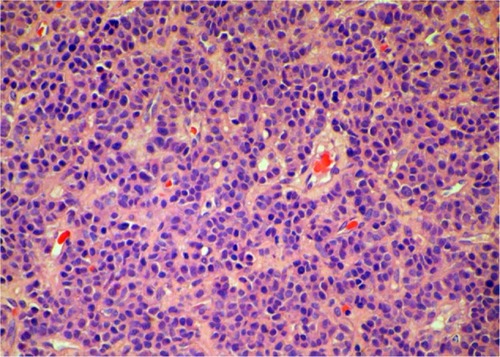 Figure 2 Hematoxylin and eosin staining of the biopsied specimen. Groups of cells have a characteristic Zellballen nested appearance. The groups of cells were composed of polyhedral cells with granular amphophilic cytoplasm.