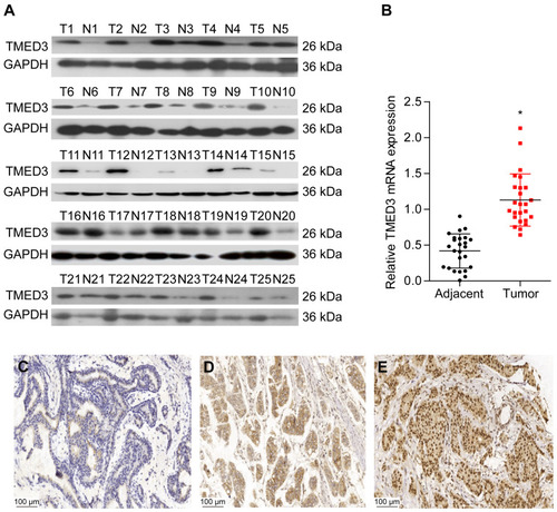 Figure 2 Expression of TMED3 protein and mRNA in breast cancer tissues.Notes: (A and B) Western blot and qPCR analysis showing the expression of TMED3 protein and mRNA in fresh breast cancer tissues and adjacent noncancerous tissues. (C) Immunohistochemistry showing negative or weak staining for TMED3 protein in noncancerous breast tissues (200×). (D) Immunohistochemistry showing moderate cytoplasmic and membranous staining for TMED3 protein in breast cancer tissues (200×). (E) Immunohistochemistry showing strong cytoplasmic and nuclear staining forTMED3 protein in breast cancer tissues (200×). *P<0.05.