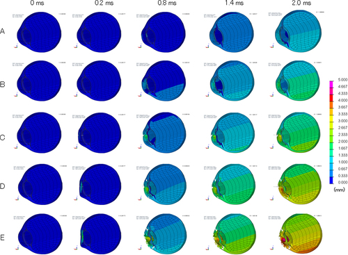 Figure 4 Sequential deformity of myopic eye upon airbag impact at five different velocities. Cases of impact velocities of 20 (A), 30 (B), 40 (C), 50 (D), and 60 m/s (E) in the normal-length model eye are shown. Results at 0, 0.2, 0.8, 1.4 and 2.0 ms after the impact are displayed. Axial deviation from the baseline position is displayed in each figure on a color-bar scale.