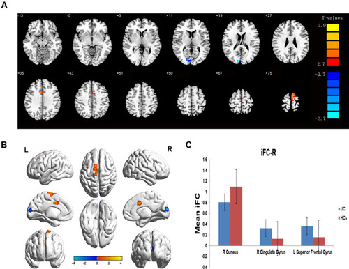 Figure 2 Differences in FC of the right V1 between patients with CU and HCs.