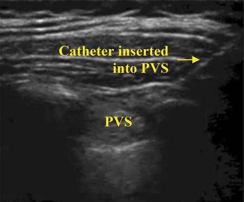 Figure 2. Catheter inserted into PVS for continous lidocaine infusion